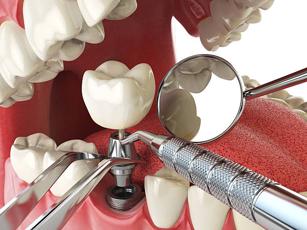 Best Emergency Wisdom Tooth Extraction in Sioux Center, IA
